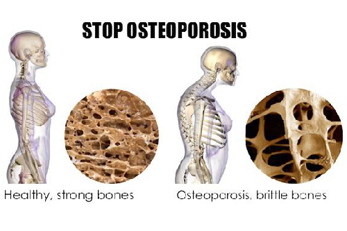 Osteopenia - sát thủ vô hình?